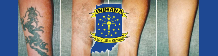 Laser Tattoo Removal in Indianapolis IN  Skin Renew Laser Center